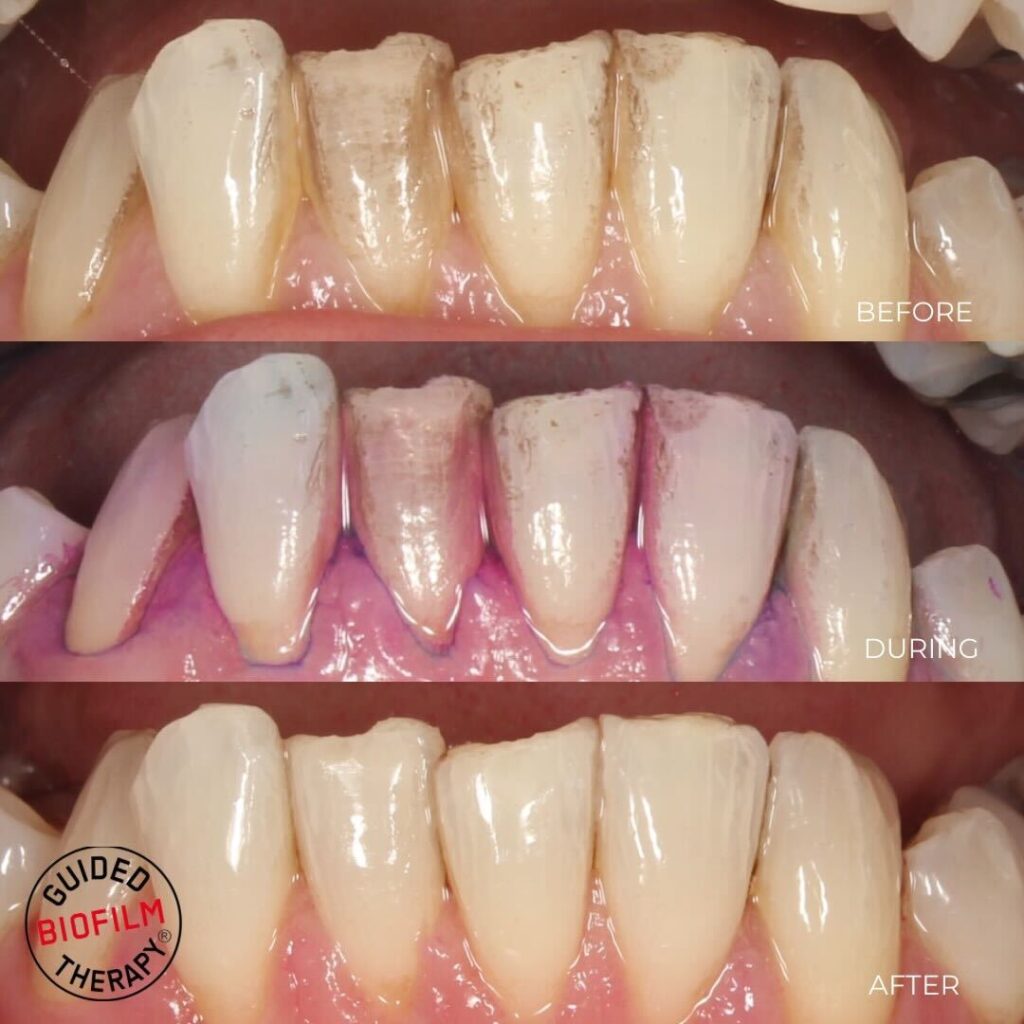 teeth being treated with airflow polishing