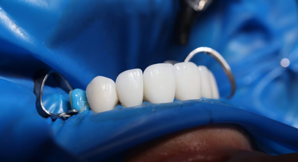 dental implants in Liverpool