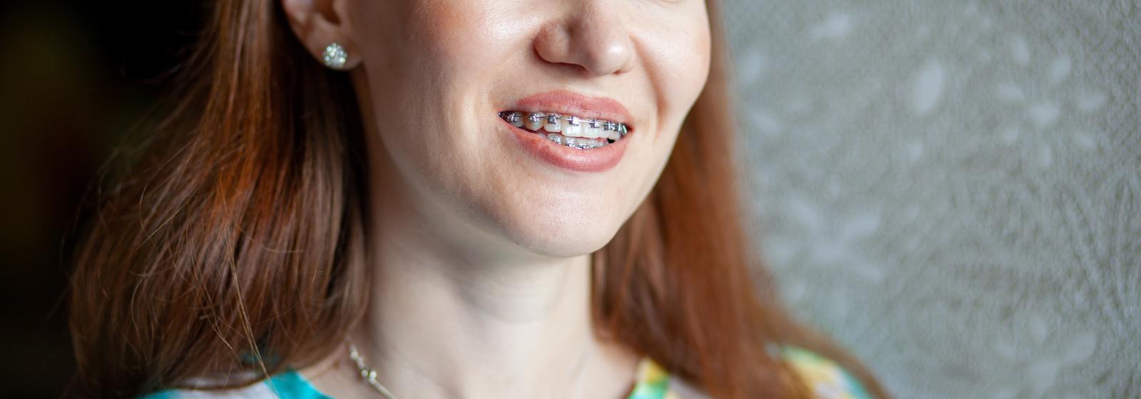 smile makeover in Liverpool