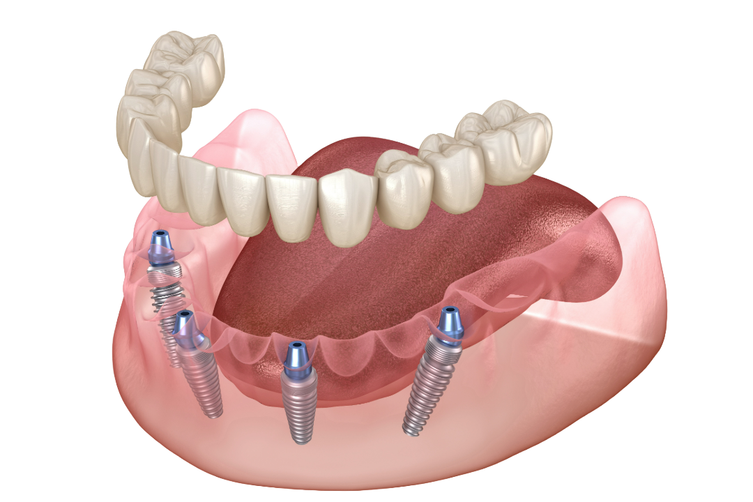 All-on-4 dental implants at Primadent, Liverpool