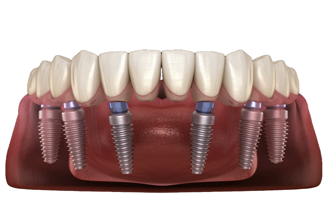 All-on-6 dental implants at Primadent, Liverpool