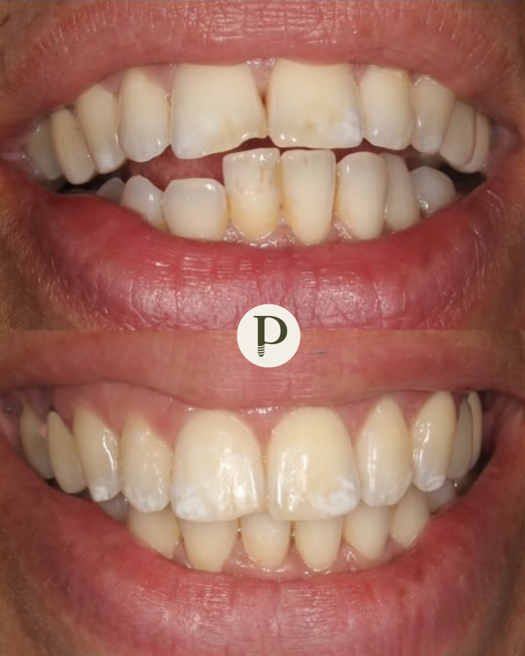 Clear aligners