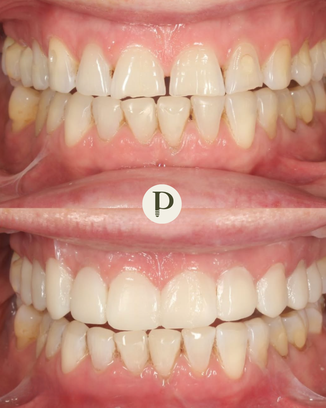 Composite veneers