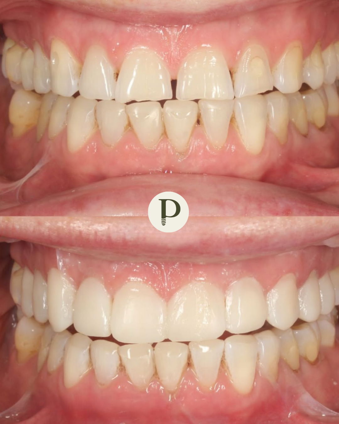 Composite veneers