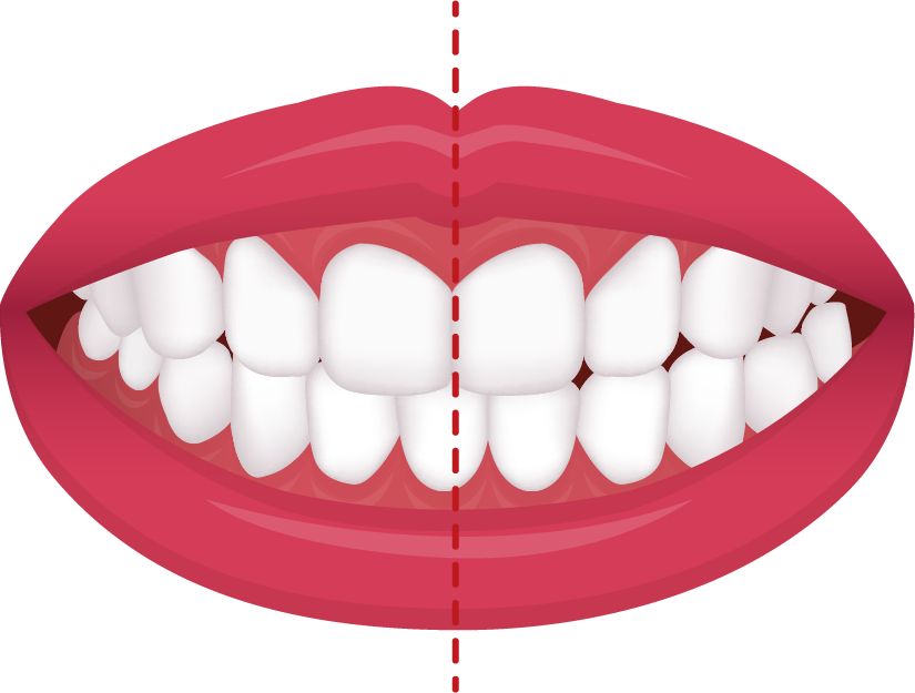 Crossbite