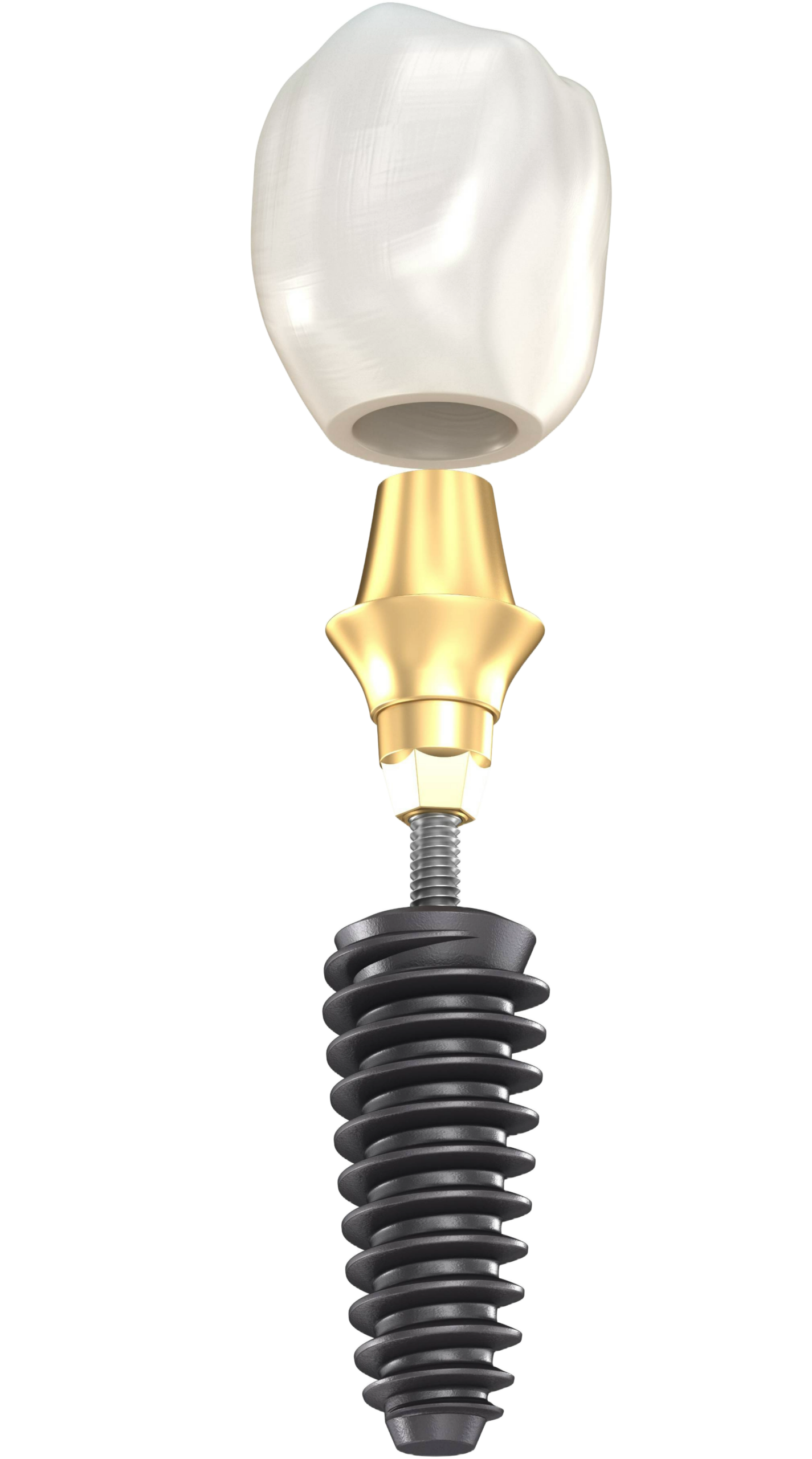 The three parts of a dental implant: crown, abutment and titanium post, at Primadent, Liverpool