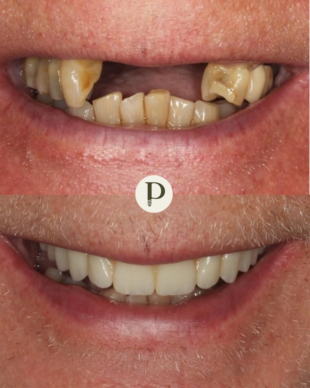 Dental implants