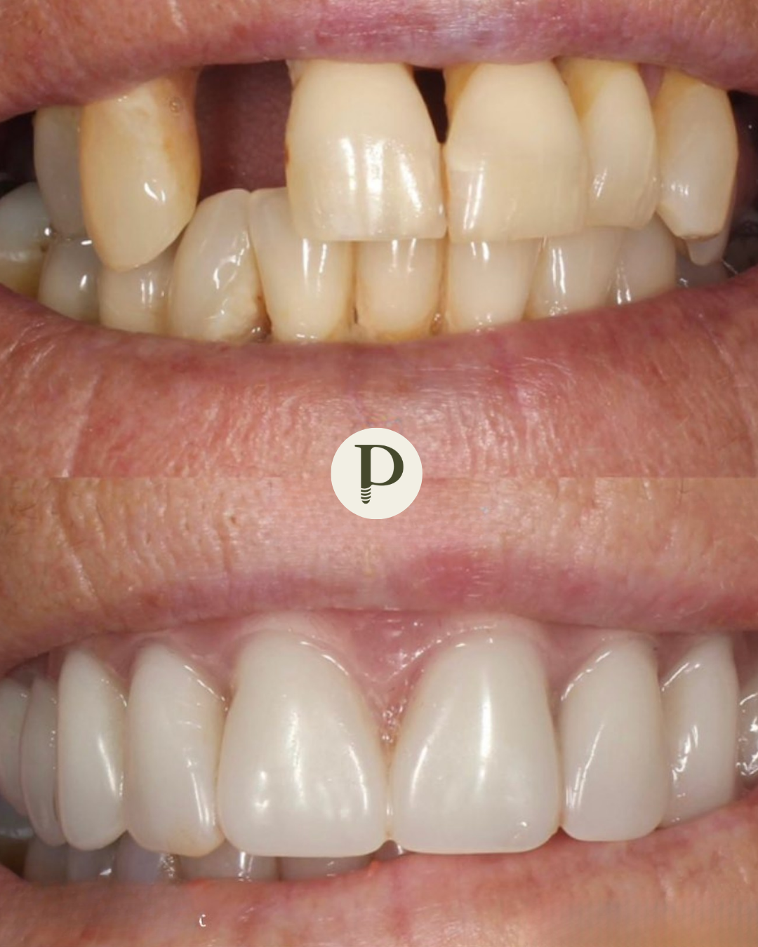 Dental implants