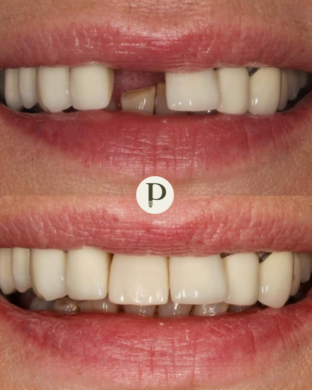 Dental implants