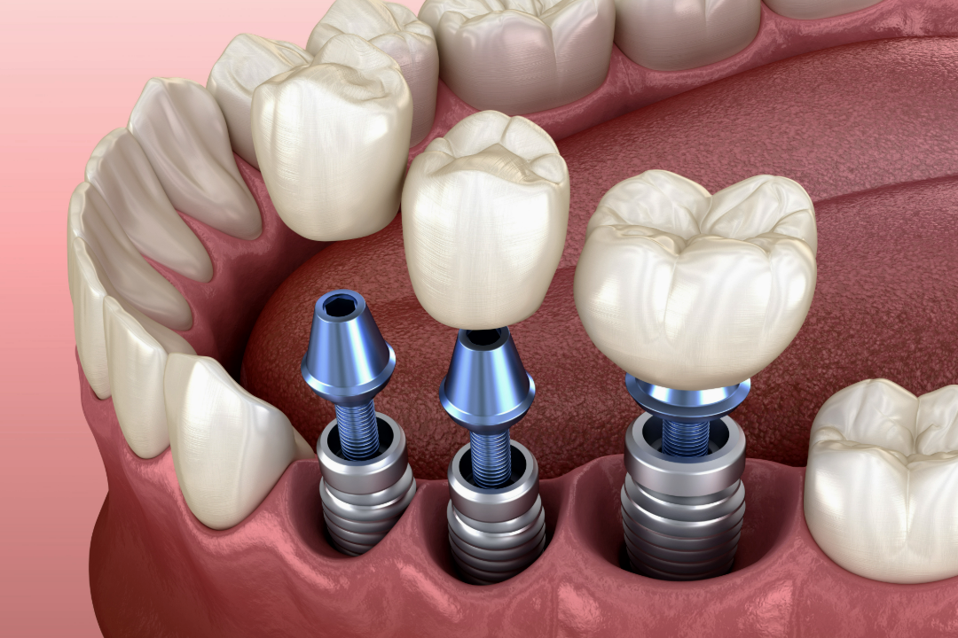 Dental implants at Primadent