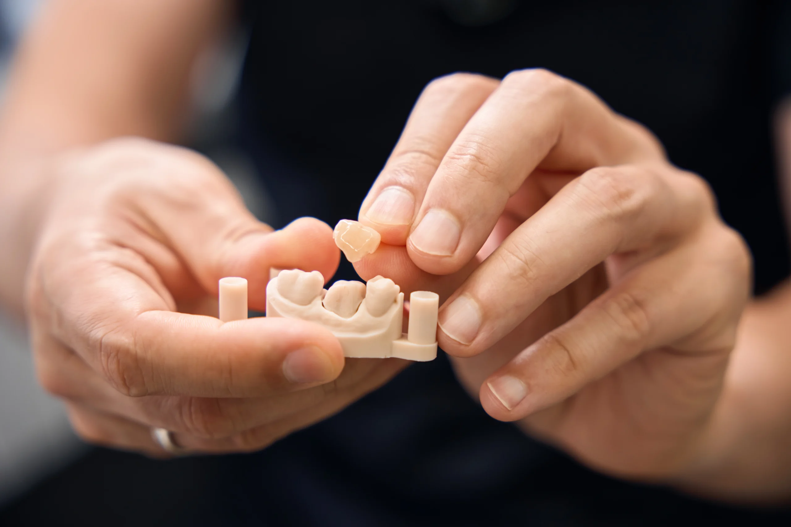 Dental crowns at Primadent Dental, Liverpool