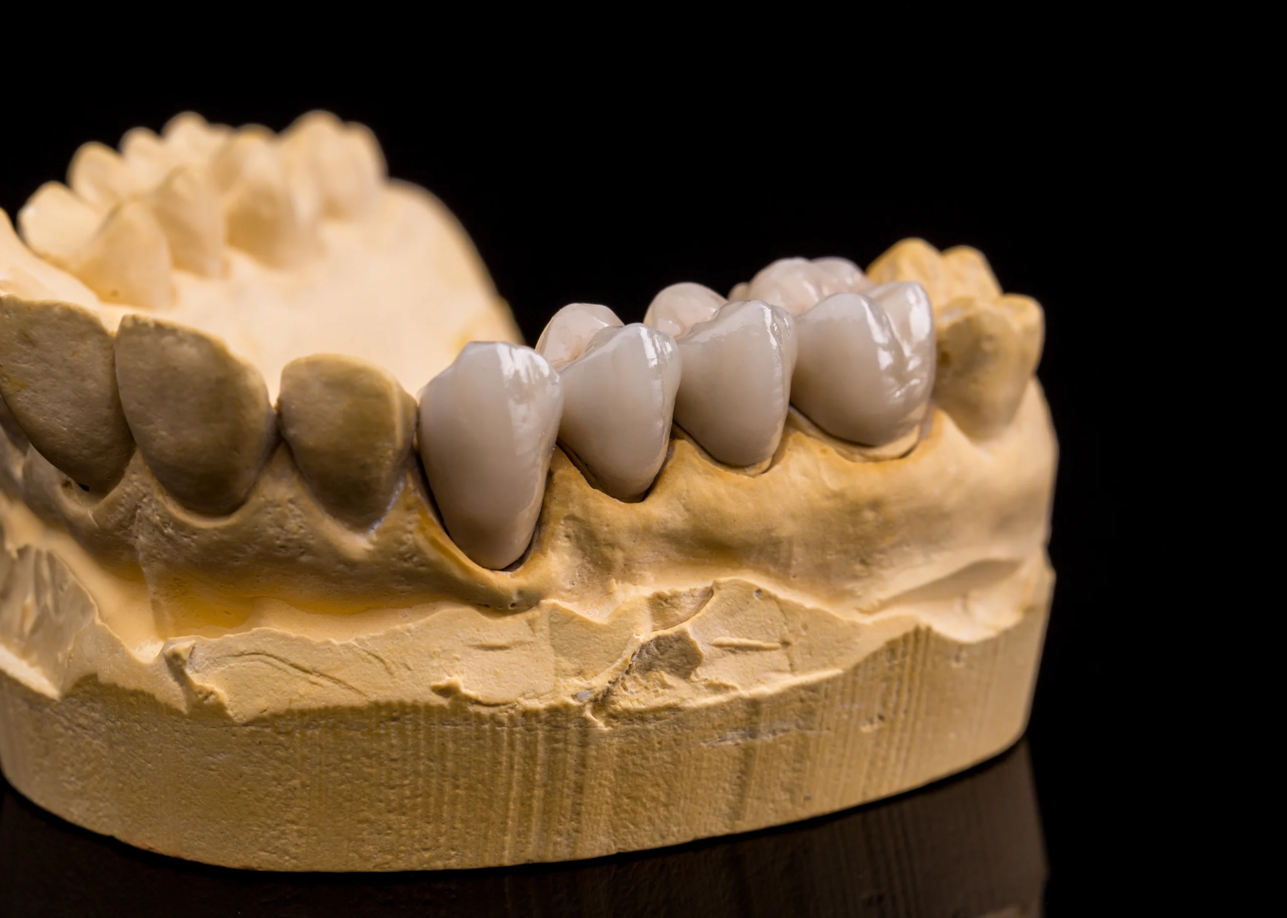 Dental bridges at Primadent Dental, Liverpool