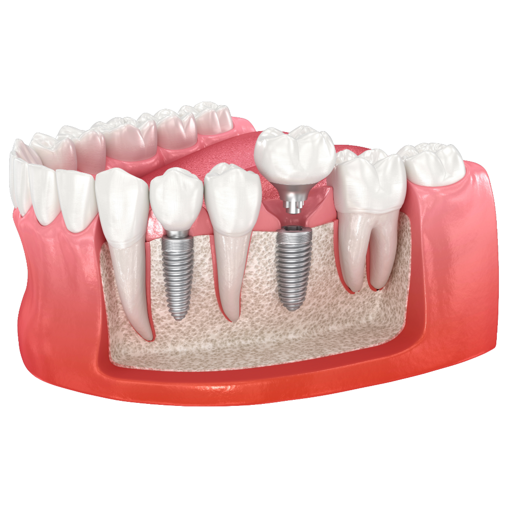 Single and multiple dental implants at Primadent, Liverpool