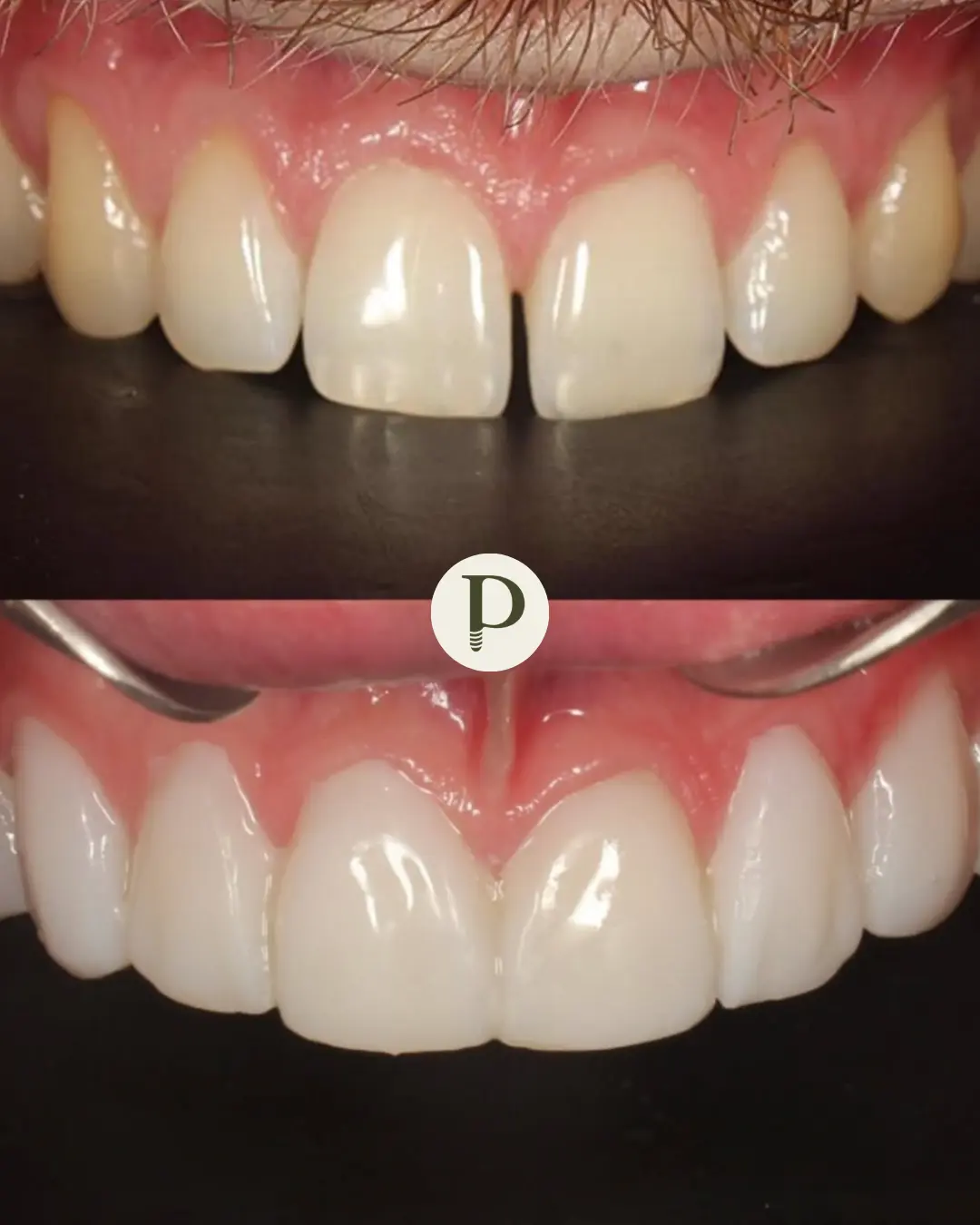 The composite bonding process at Primadent, Liverpool