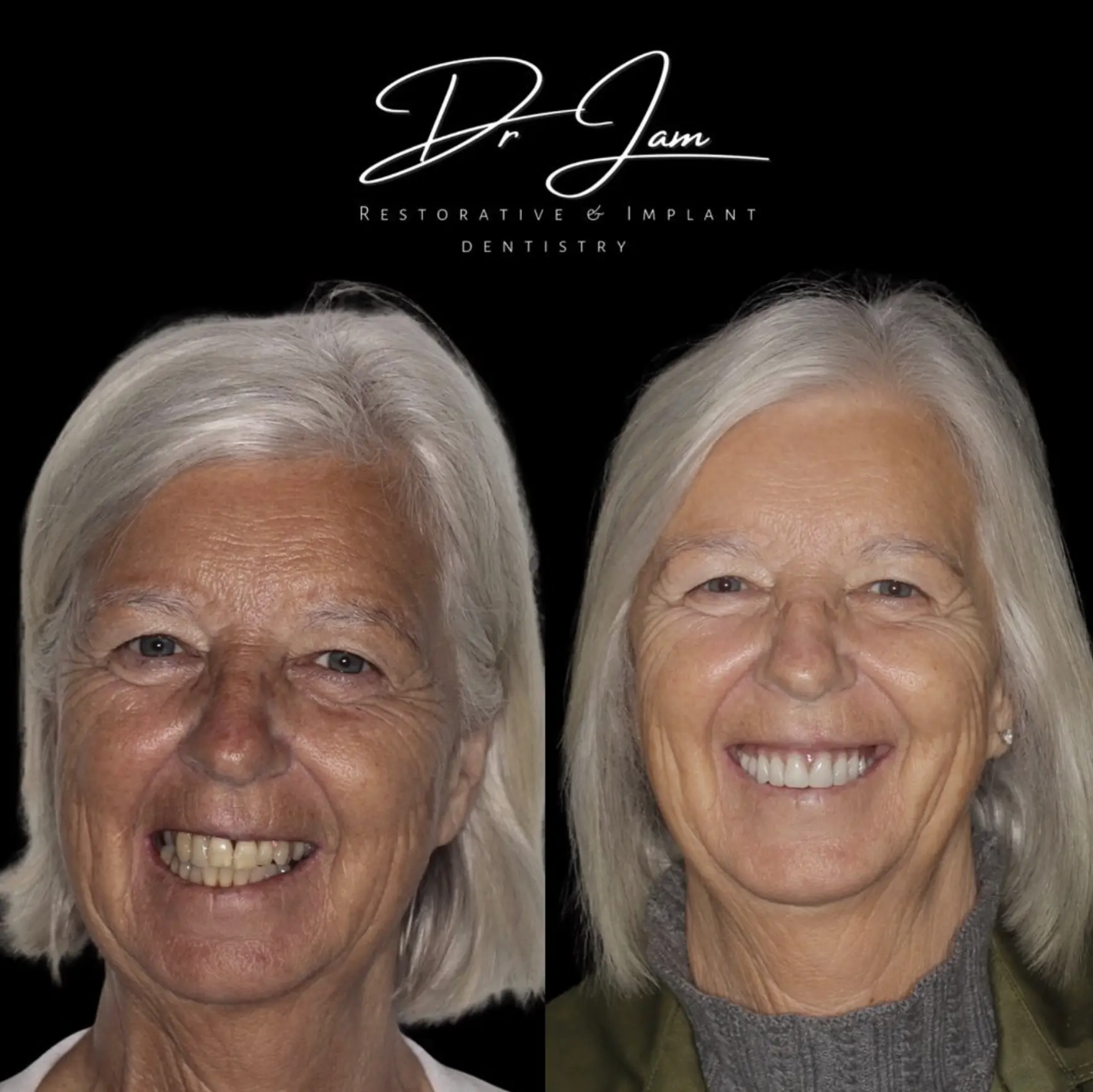 All-on-4 and All-on-6 dental implants at Primadent, Liverpool