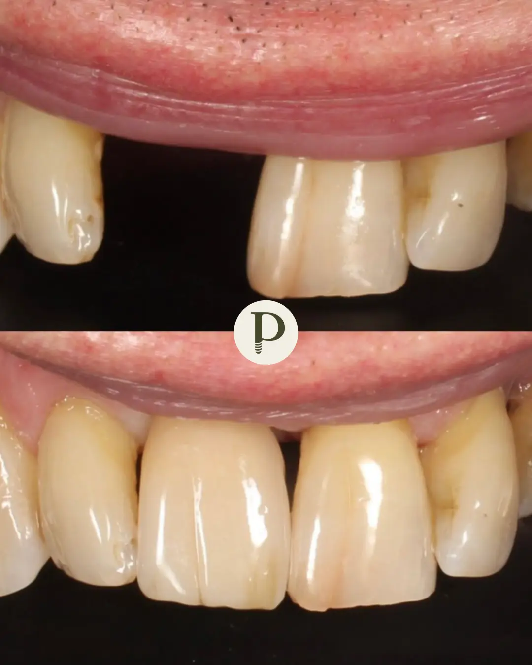 Dental implants at Primadent, Liverpool